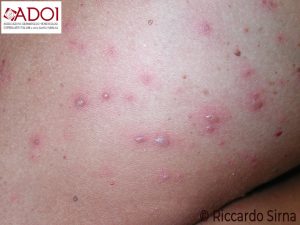 Varicella | Adoi